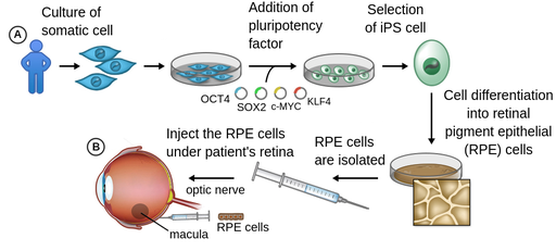 Image representing the different steps when treating retinal diseases with iPS cells. There is a person's silhouette and an arrow pointing toward a group of cells. Those cells are cultured and pluripotency factors are added. Another arrow points to show that the cells have become i P S cells. There is a selection of i P S cells so they can be cultured again and differentiated into retinal pigment epithelial cells. An arrow pointing from this second culture to a syringe, showing that these R P E cells are isolated and injected under patient's retina. A final arrow points to an illustration of a human eye.