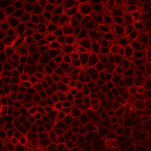 E-cadherin在乳腺癌上皮细胞中的表达