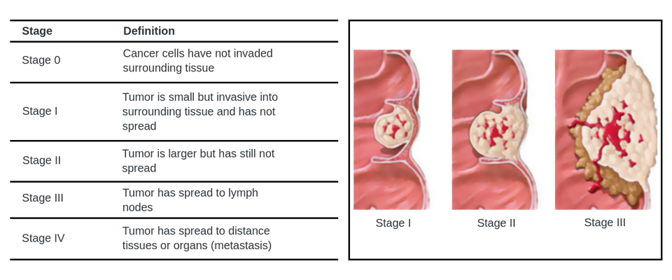 colon cancer stage 0