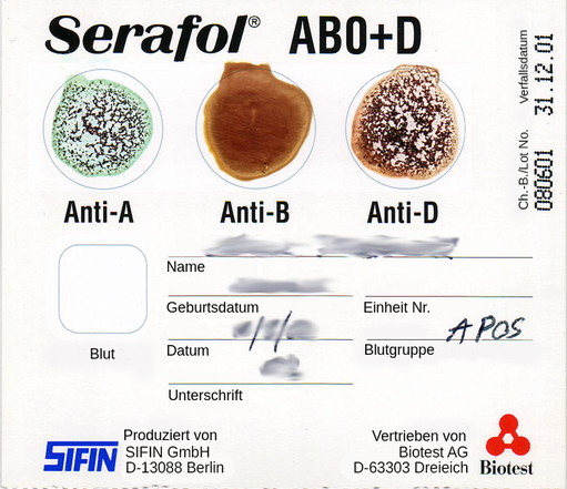完成的血液键入测试卡。卡片顶部出现三个圆形字段，从左到右标记：抗A，抗B和抗D.抗A和抗D的血液凝固发生，而抗B场没有凝血。在圈子下方，该卡填写患者信息，如姓名和出生日期，以及血型结果，这在此卡上是一个积极的。