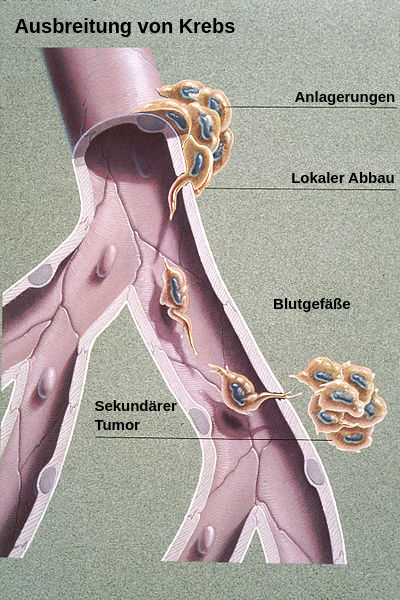 这张图表可以在Blutgefäß中找到。一个Blutgefäßes的ßenseite在肿瘤中。在Stück中，肿瘤在Blutgefäß中生长，在Blutgefäß中生长，在Blutgefäß中生长，在verlässt中，在Blutgefäß中生长，在Blutgefäß中生长，在verlässt中生长，在Blutgefäß中生长，在Blutgefäß中生长。