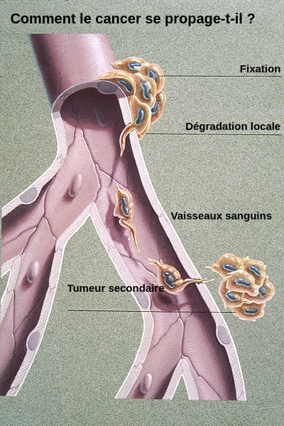 Schéma蒙特兰特联合会跨越ristversale d'联合国Vaisseau sanguin。Unetumeurestationéeàl'extérieurdu Vaisseau sanguin。Un Morceau de la Tumeur Entre Dans Le Vaisseau Sanguin et Le Traverse，Puis Sort Du VaisseauSanguinà联合国尾随Enroit et开始à前Unereuutièmetumeur。